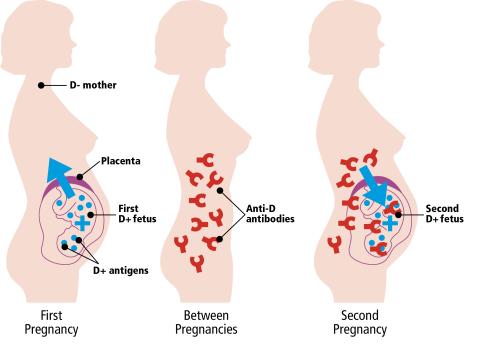 Diagram showing antibodies and antigens in first pregnancy, between pregnancies and second pregnancy