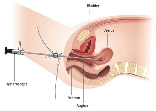Diagram showing a hysteroscope inserted in the uterus