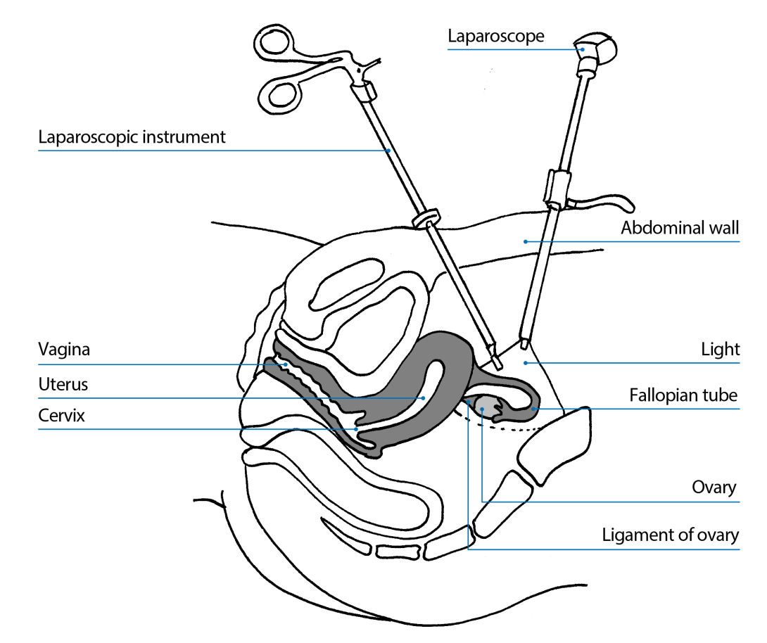 A labelled diagram showing a laparoscope and instrument in a uterus