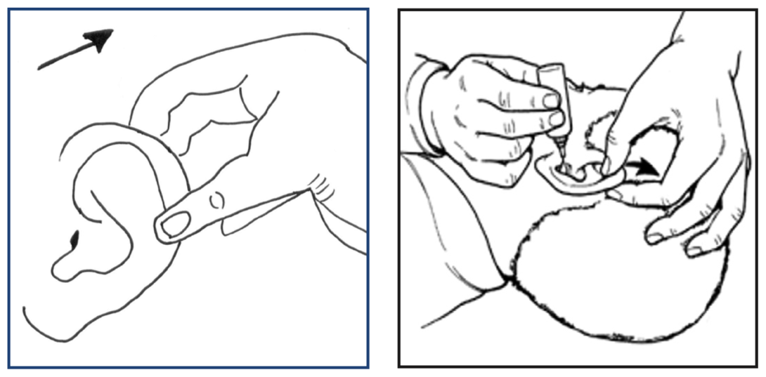 A diagram showing the top of the ear being pulled and ear drops into the ear canal