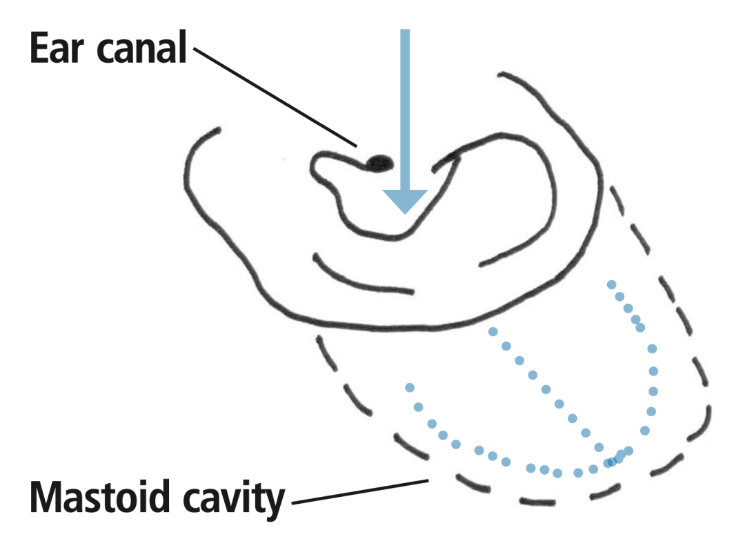 A diagram showing the mastoid cavity behind the ear canal